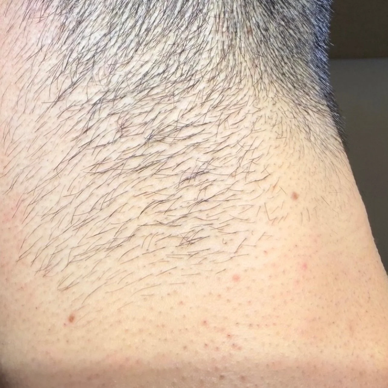 A sharper hairline starts here! Swipe to see the transformation ➡️

This client came in looking to refine and clean up his hairline, and electrolysis delivered precise results after just one session.

#LimogesBeauty #Electrolysis #PermanentHairRemova