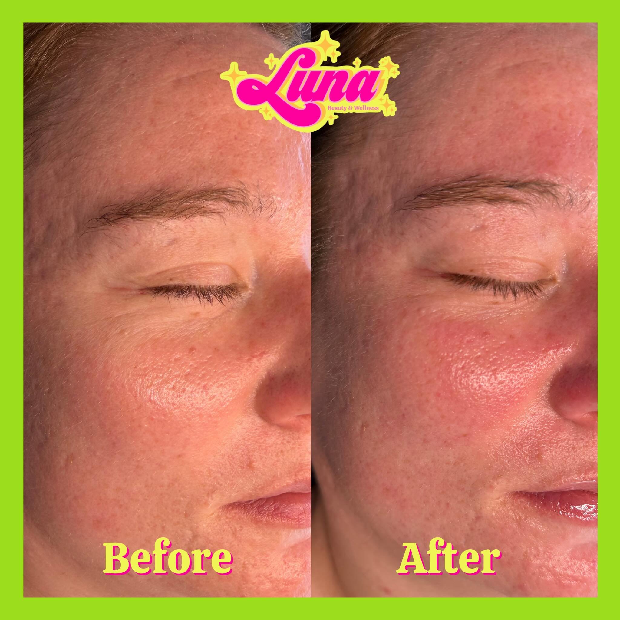 Before &amp; immediately after our first chemical peel of the series. 

We can already see the skin looking more hydrated and supple.

When doing a chemical peel series we start off gentle, and week by week increase strength &amp; time of the peel. B