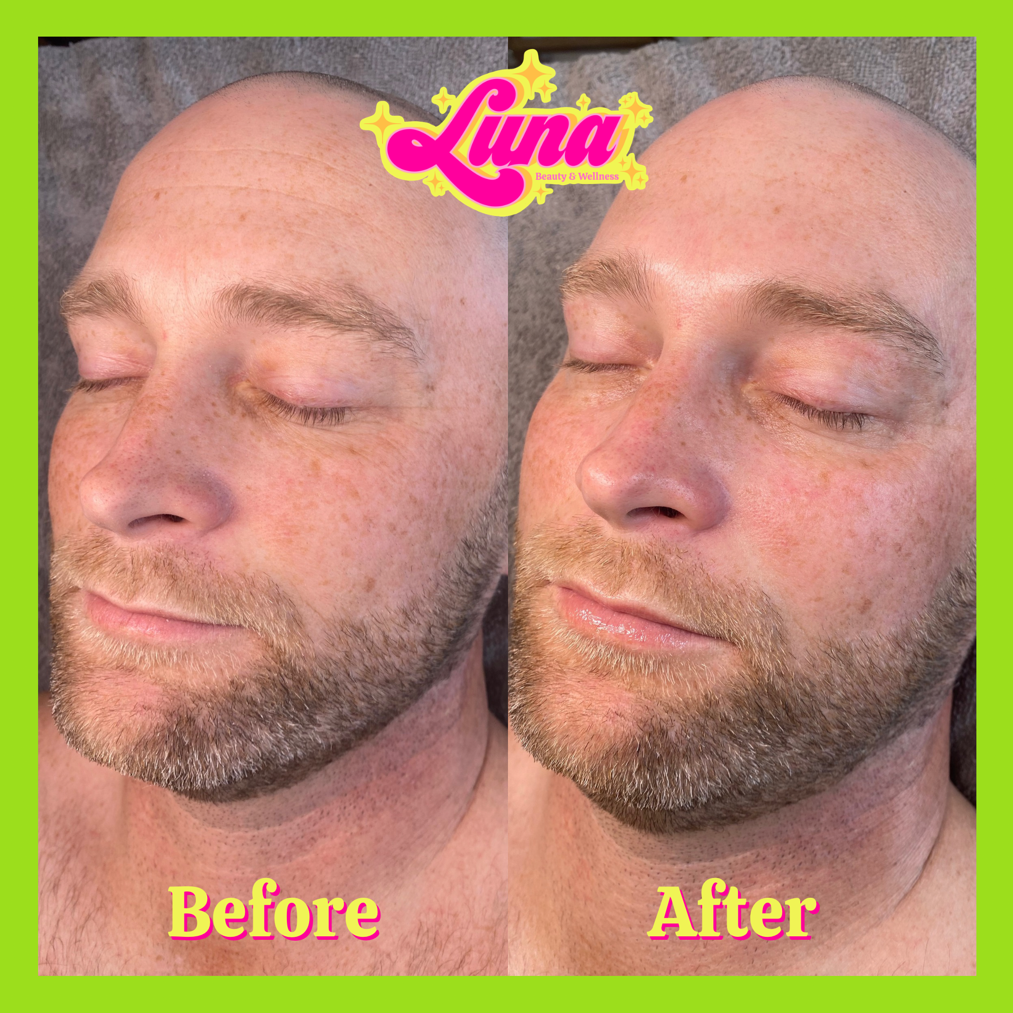 Photo shows the before and after of a brightening facial. The after photo shows less noticeable sun damage, less inflammation, less fine lines and wrinkles and an overall glow.