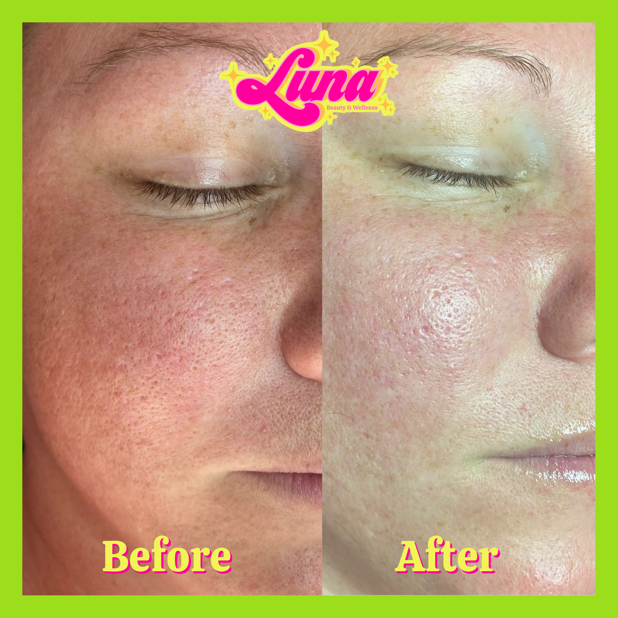 Close-up of a woman's face showing a skincare transformation, with a 'Before' image on the left displaying visible pores and redness, and an 'After' image on the right showing smoother, clearer skin.