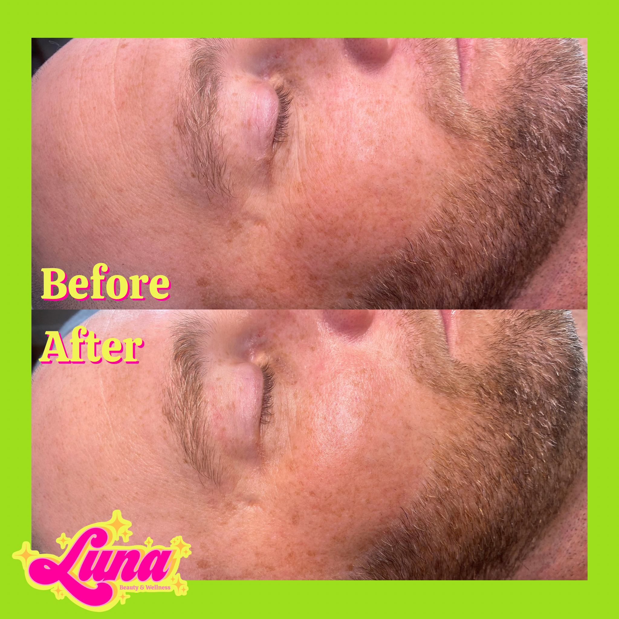 A close up photo comparing a man's skin before and after a brightening facial. The after photo shows lightened hyperpigmentation and lessened appearance of fine lines and wrinkles. The face also looks more hydrated and glowing.