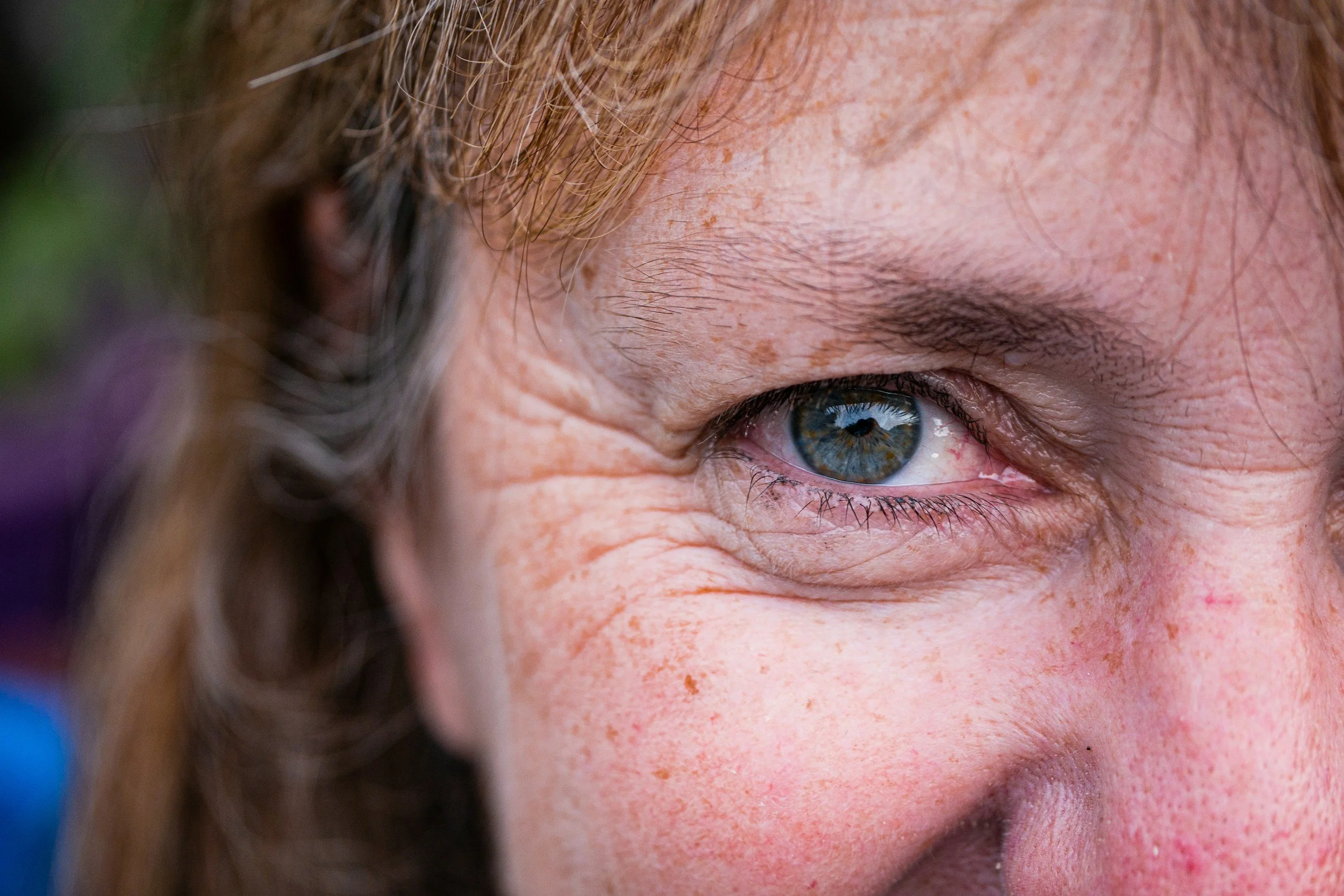 Xeomin in Phoenix: Subtle Wrinkle Relaxing With Elegant Results