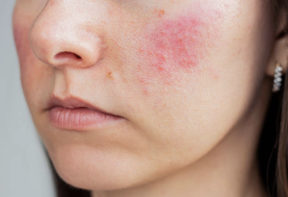 Rosacea in Phoenix: Managing Chronic Redness in a Hot, High-UV Climate