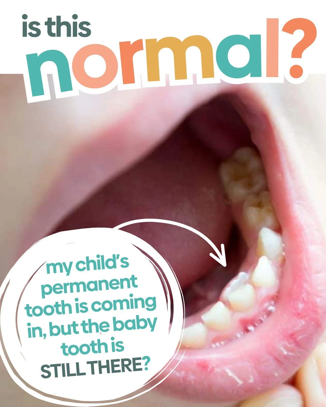 You look in your kid&rsquo;s mouth and suddenly there are TWO rows of teeth. 😳🦷
Before you head down the Google rabbit hole, this is one of those things we see pretty often!

See something that has you wondering? Ask your Krewe! 🩵🧡