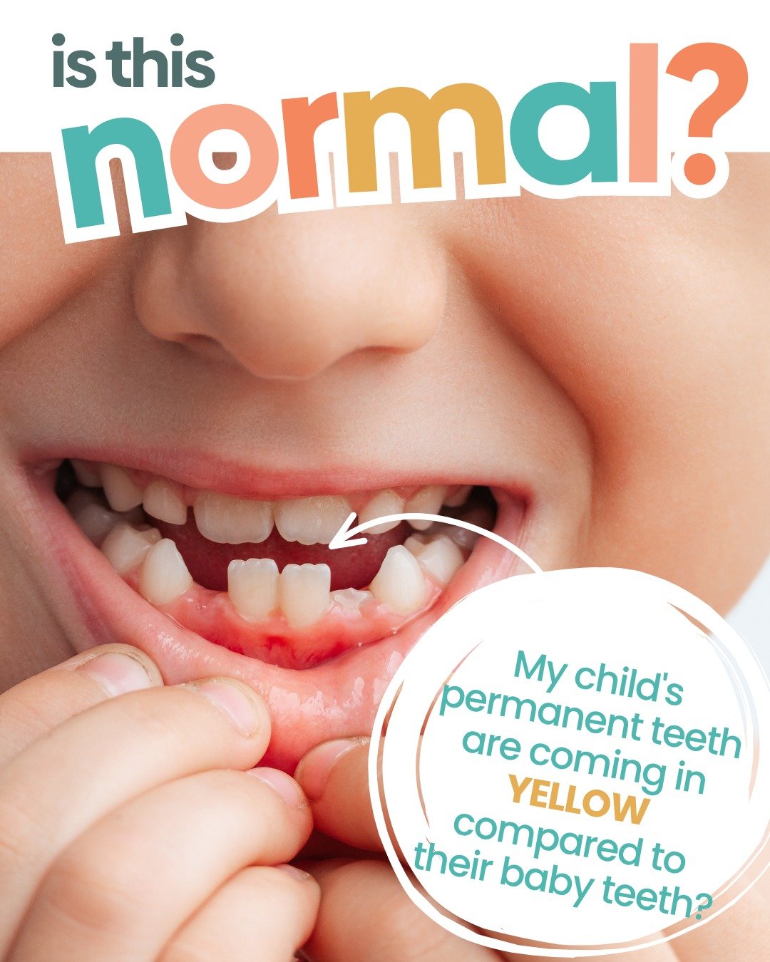 Wait... why are my kid's new teeth so YELLOW?! 😳🦷

If you've ever noticed that your child's permanent teeth look a little more yellow than their baby teeth, you're definitely not alone!
Good news: It's often completely normal! 🙌

Swipe through for