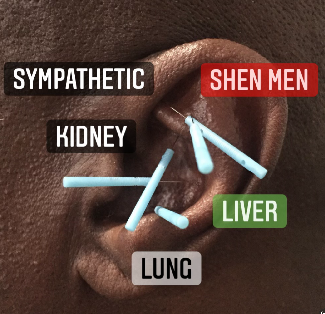 Labels on an ear with acupuncture needles, indicating points for sympathetic, Shen Men, kidney, liver, and lung.