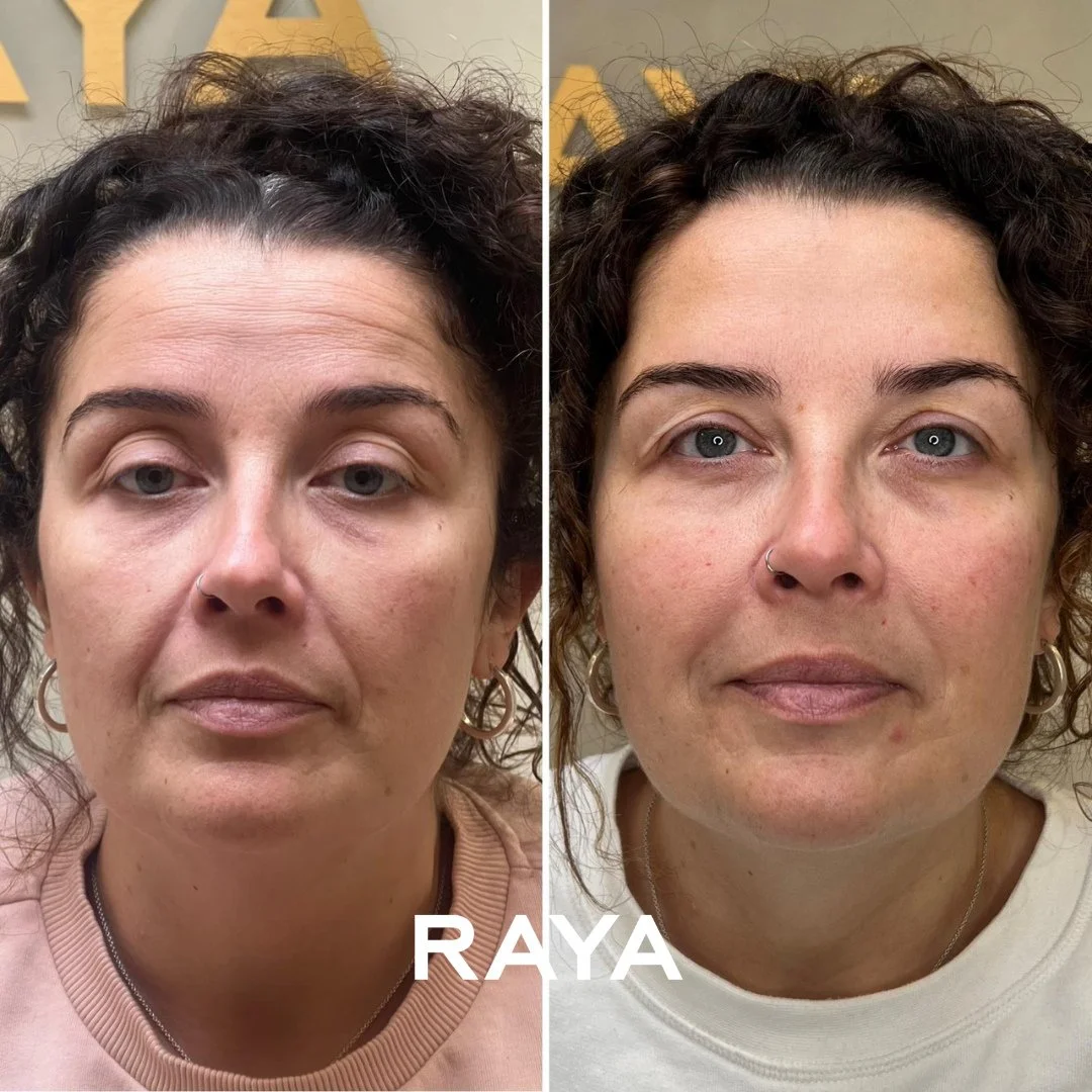 Treating lines around the mouth 👄
Lines around the mouth, such as nasolabial folds (the creases that run from the nose to the corners of the mouth) and marionette lines (that pull the corners of the mouth downward), are some of the most common ag