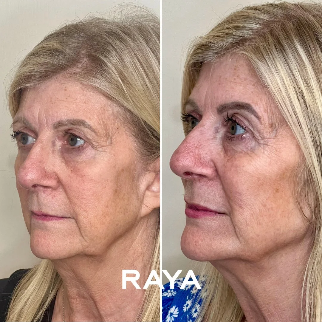 A moment for one of our fabulous 2025 transformations ✨⁠
⁠
As we drift between Christmas and the New Year, it feels like the perfect time to reflect on the subtle, confidence-boosting results our clients have achieved this year...⁠
⁠
Subtle enhanceme