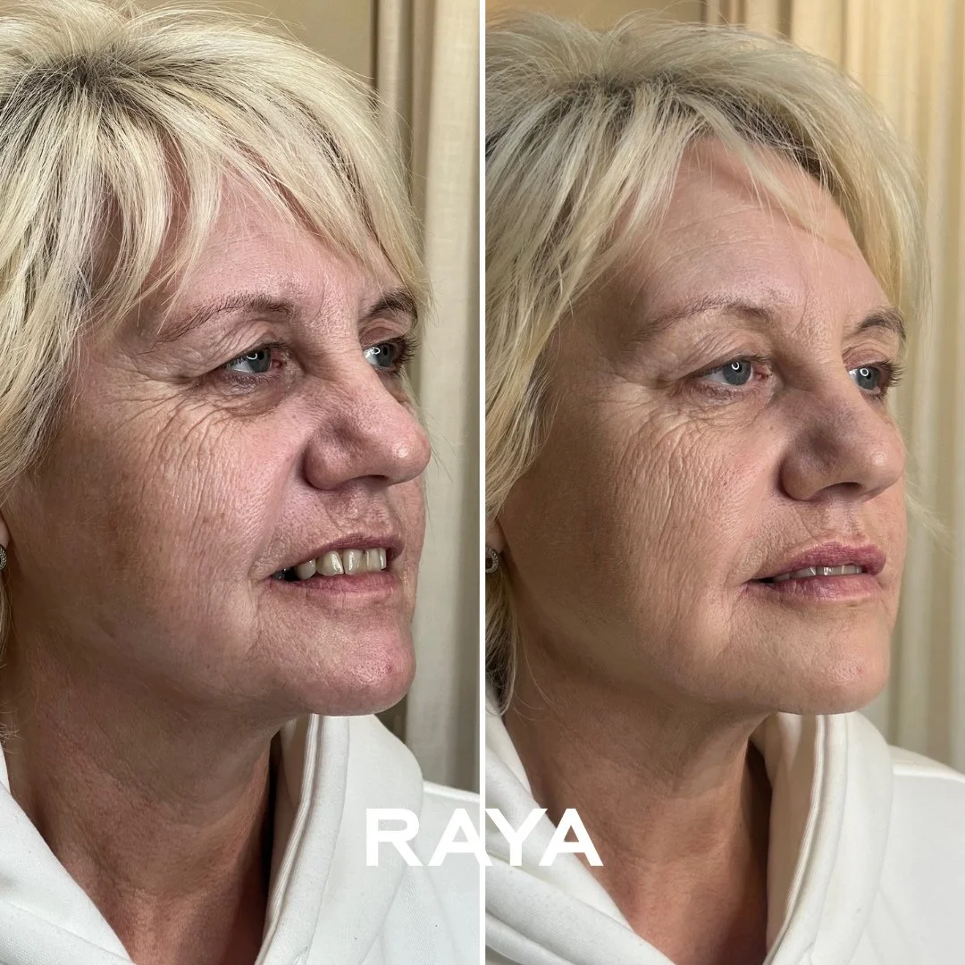 2025 was about powerful yet subtle transformations ✨⁠
⁠
This beautiful result was created using 6ml of carefully placed dermal filler across key areas including the cheeks, nasolabial folds, top lip, pre-jowl sulcus, and complemented with a touch of 