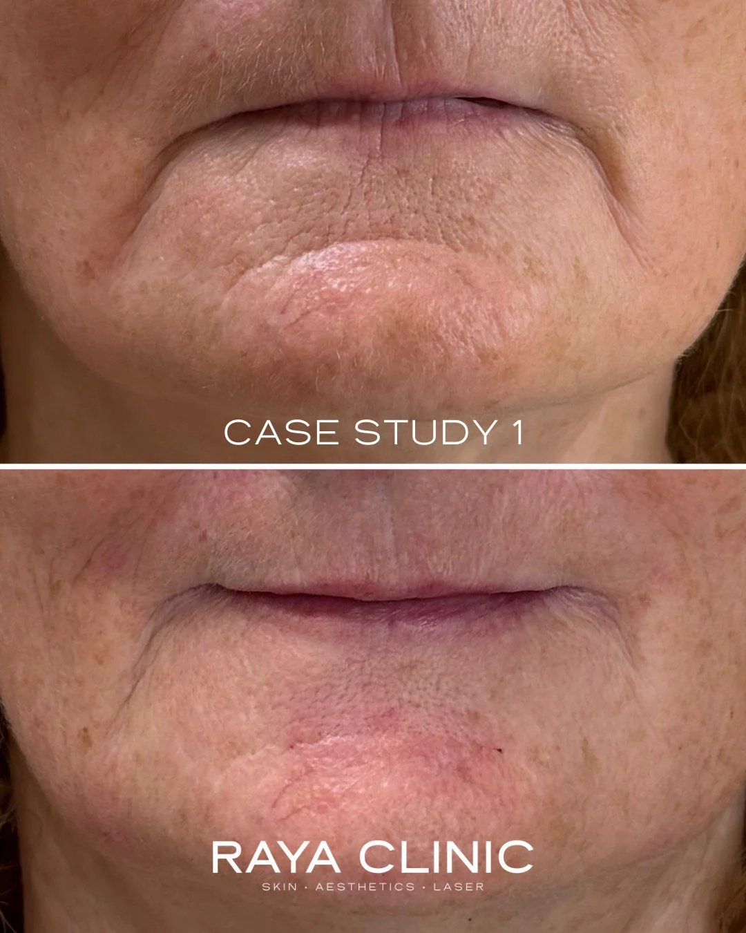 Are you struggling with a downturned or &ldquo;sad&rdquo; looking mouth?⁠
⁠
This is a common concern we see in clinic!⁠
⁠
As we age, changes around the mouth are very common. Loss of collagen and bone support, changes in muscle activity, and volume d