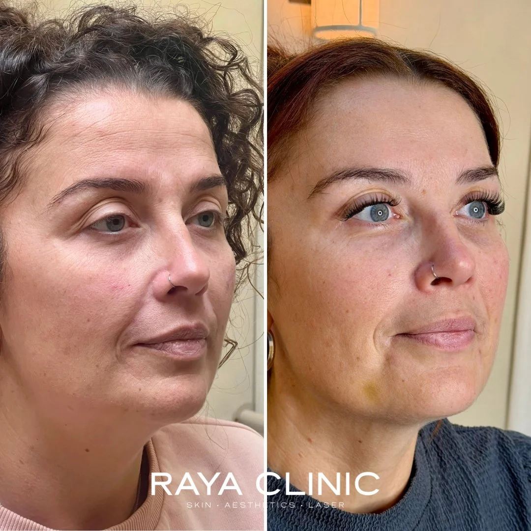 A subtle lift. Restored balance. Confidence renewed ✨⁠
⁠
This transformation is a beautiful example of what expertly placed dermal filler can achieve when the face is treated holistically - not area by area.⁠
⁠
Dermal filler was carefully placed in t