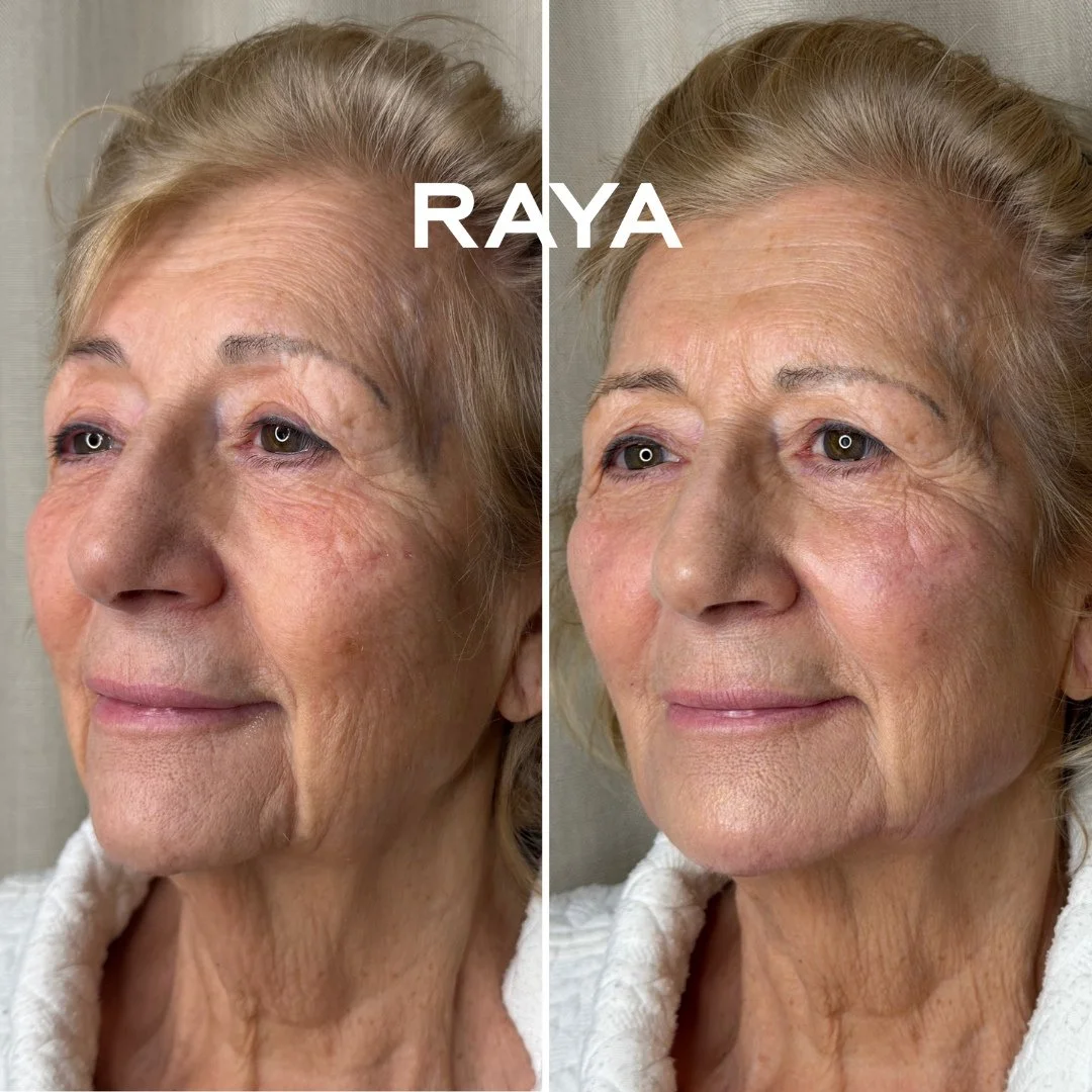 Most people wouldn&rsquo;t know what&rsquo;s changed here&hellip; but they&rsquo;d say she looks fresher. ✨️⁠
⁠
This is my mum who is in her 70s. And this is what full-face rejuvenation looks like at RAYA!⁠
⁠
No drastic alteration.⁠
No chasing youth.