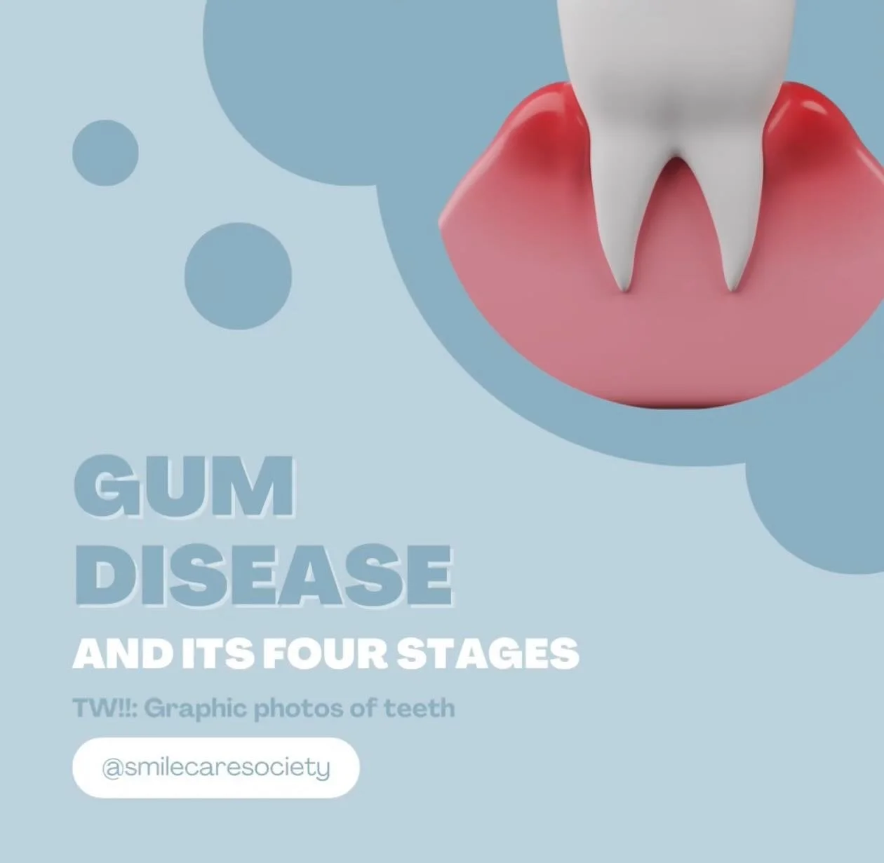 Exploring the Four Stages of Gum Disease! 🦠🦷 Did you know that gum disease progresses through distinct stages? From gingivitis to advanced periodontitis, understanding these stages is crucial for maintaining oral health! Stay informed, stay healthy