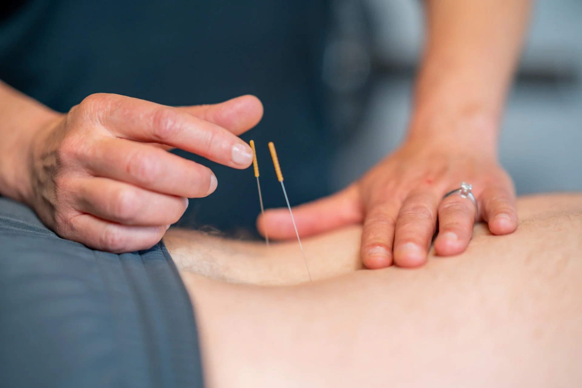 Acupuncturist inserting needles into a person's back during treatment.