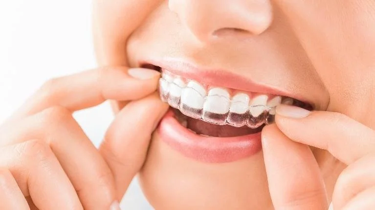 Close-up of a person inserting Invisalign clear aligners, illustrating the discreet and removable nature of the orthodontic treatment.