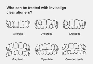 Illustration showing different bite issues such as overbite, underbite, and crossbite, explaining who can be treated with Invisalign clear aligners.