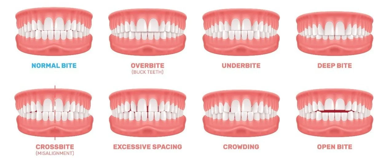 Illustration showing different orthodontic issues such as overbite, underbite, crowding, and crossbite, highlighting common problems treated with early intervention.