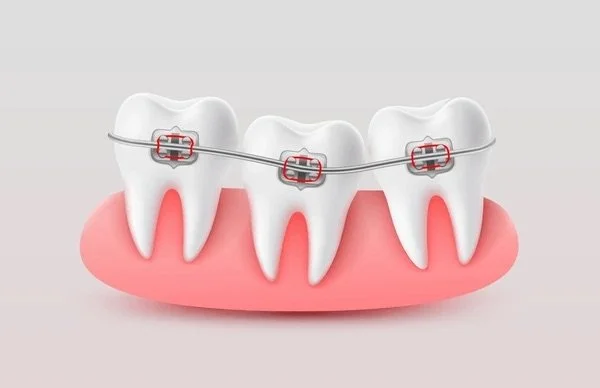 Illustration showing how braces are applied to teeth, explaining the function of brackets and wires in orthodontic treatment.