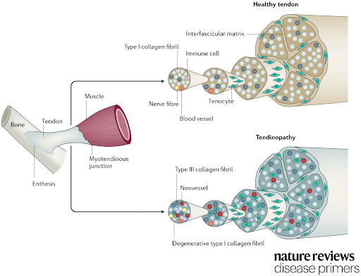 Bone stress injuries and the effects on bone mineral density