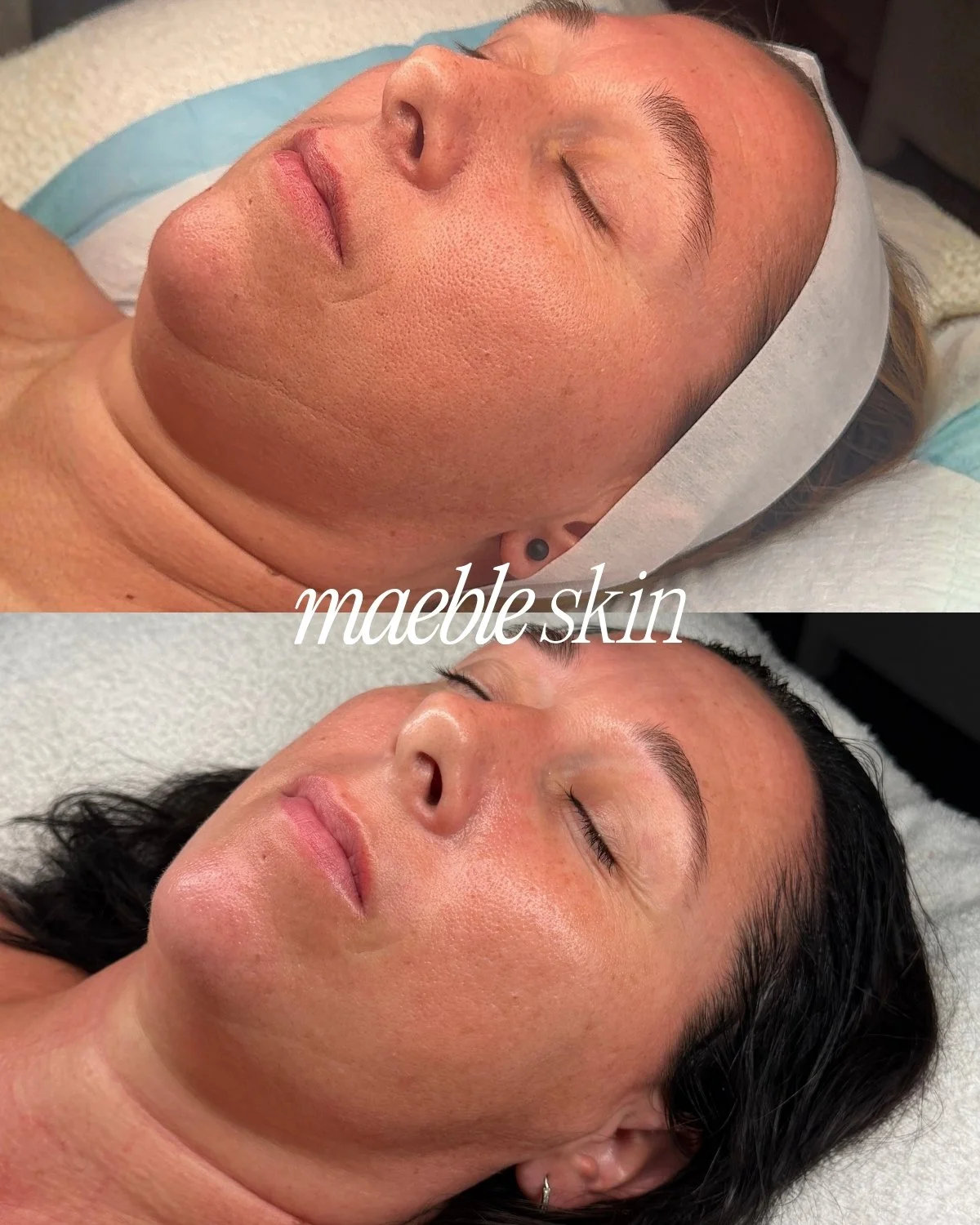Before and after photos of a woman with the words 'maeble skin' in the center, showing a skin treatment or facial healing process.