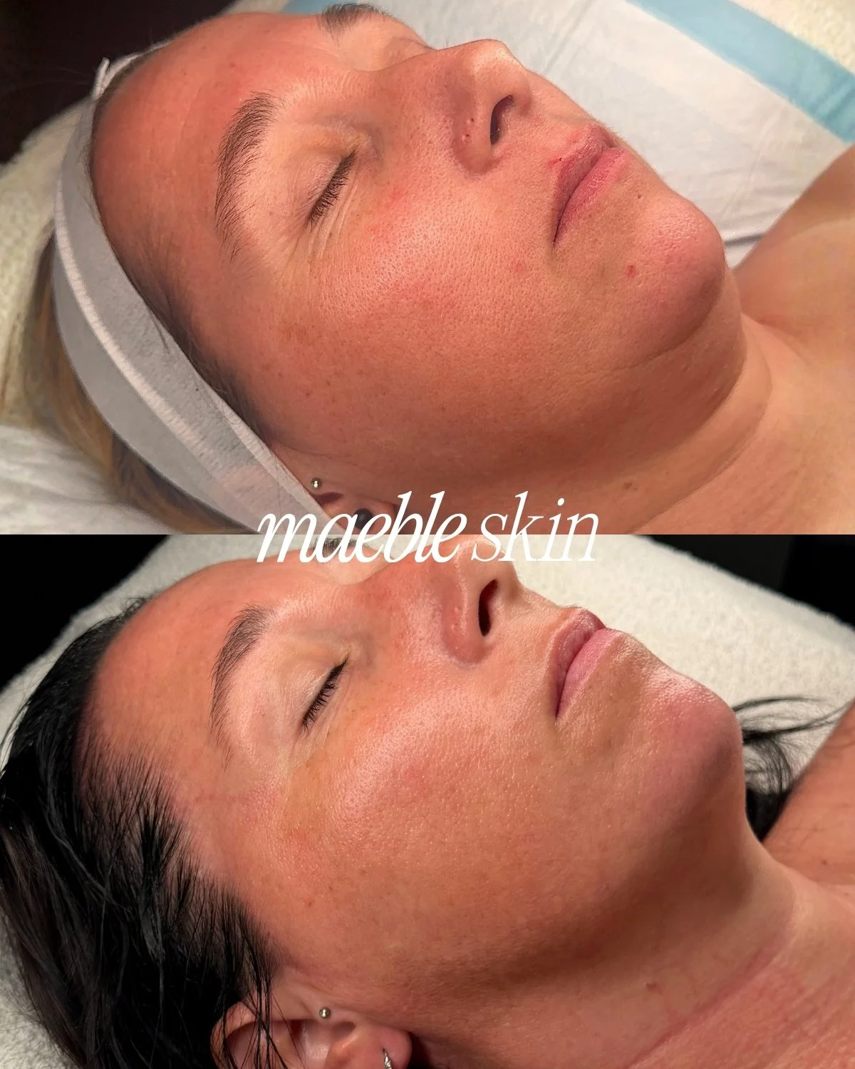 Comparison of a person's face before and after a skincare treatment, highlighting smoother and clearer skin. The top image shows the face with uneven skin texture, while the bottom image shows improved, dewy skin. The words 'mable skin' are overlaid.