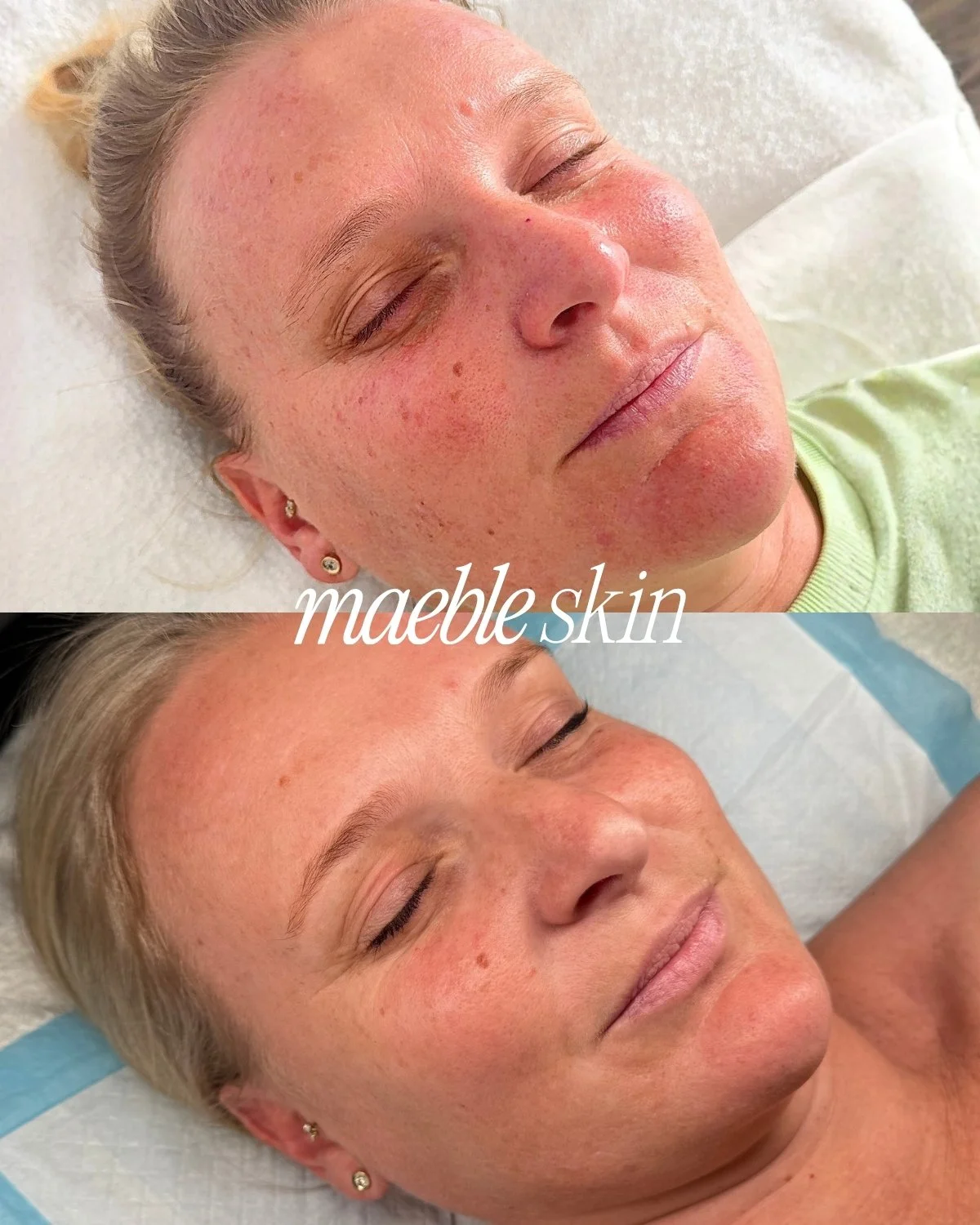 Before and after images of a woman with madble skin, showing skin improvement from treatment.