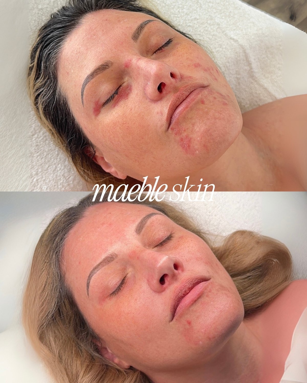 Side-by-side comparison of a woman with textured, blemished skin before and after skin treatment, showcasing smoother and clearer skin at the bottom. The words "maeble skin" are overlaid on the image.