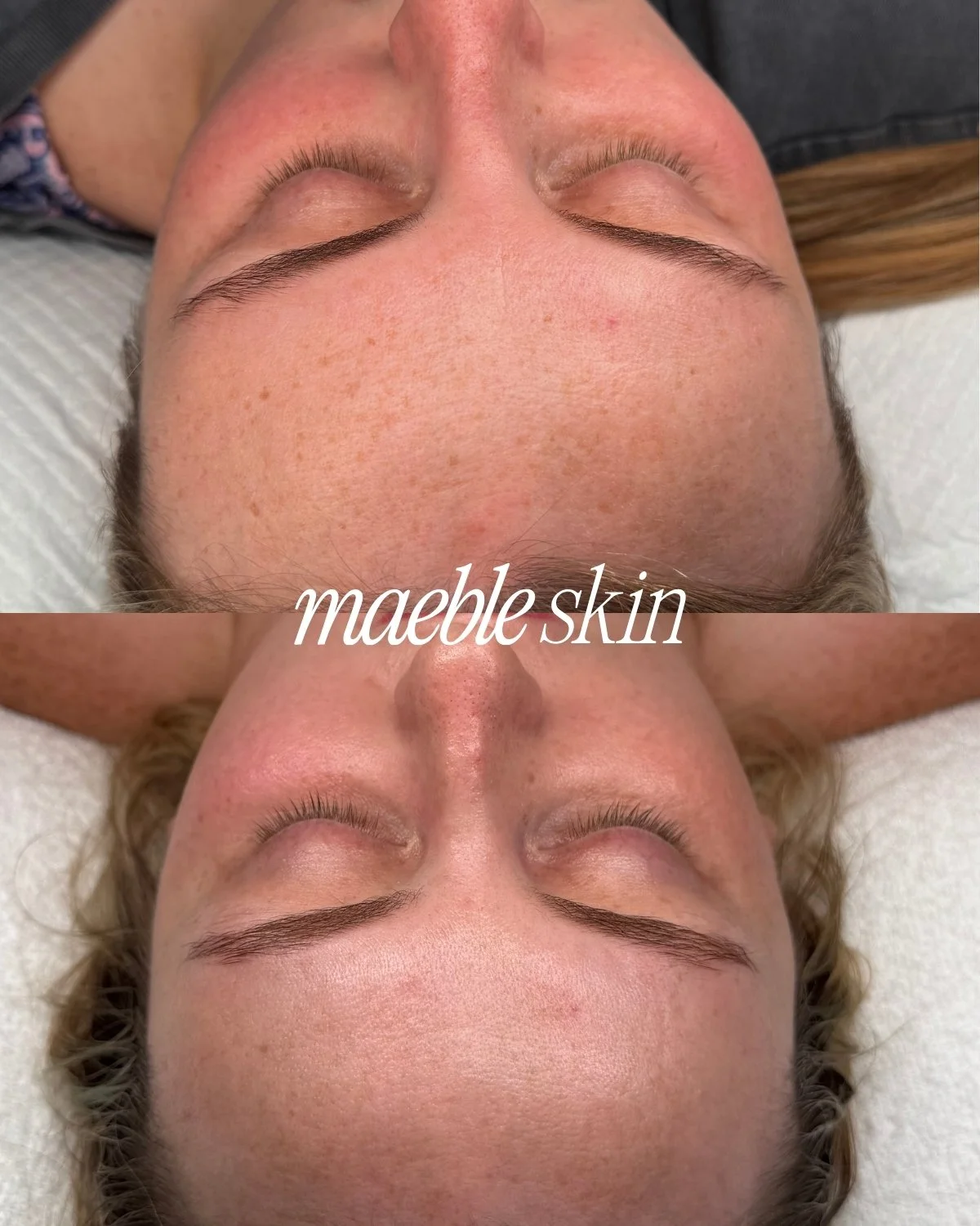 Close-up of a woman's forehead before and after a skin treatment, showing smoother, clearer skin in the after photo, with the words 'maeble skin' overlayed.