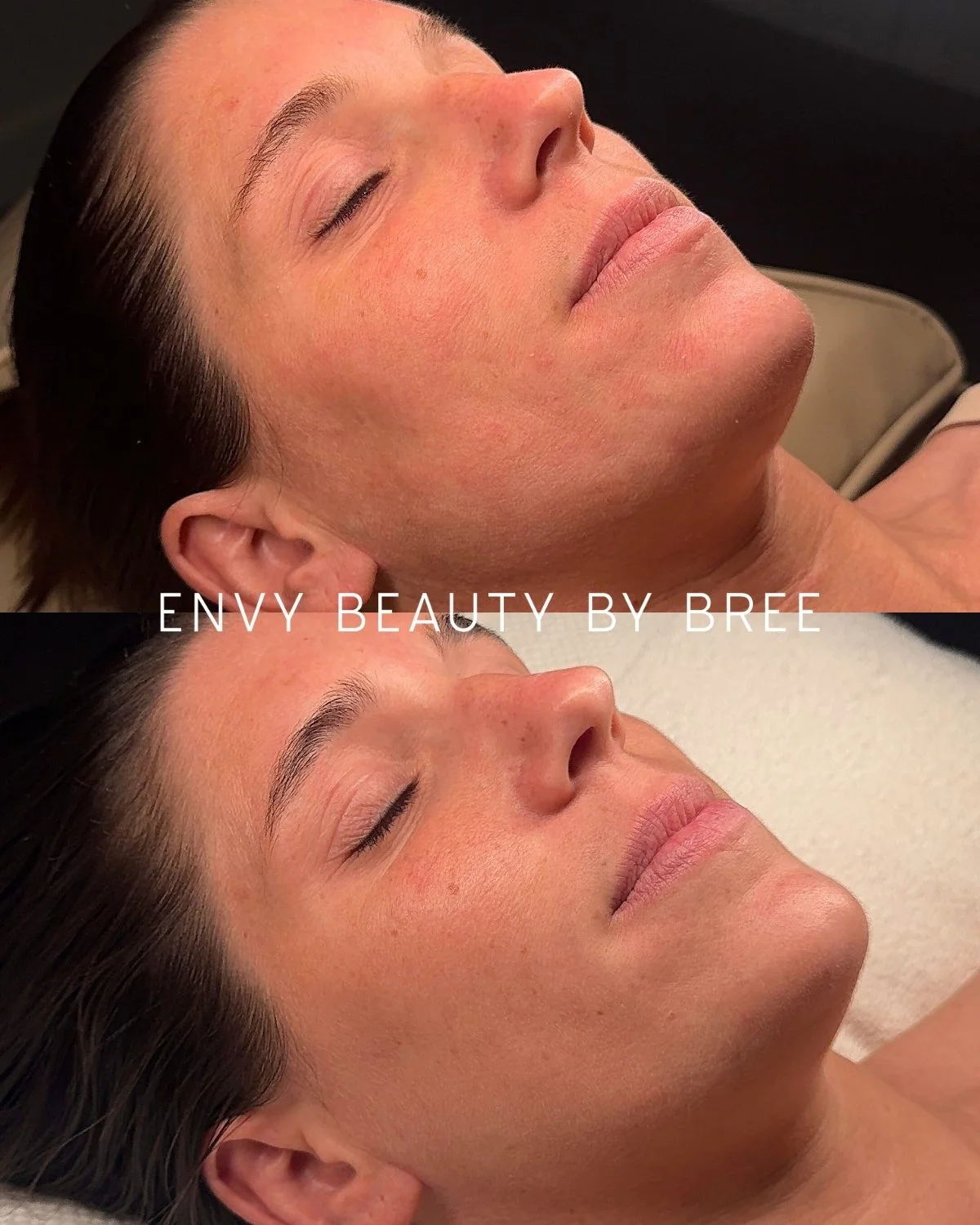 A side-by-side comparison photo showing a woman with smooth, clear skin before and after a beauty treatment, labeled 'Envy Beauty by Bree'.