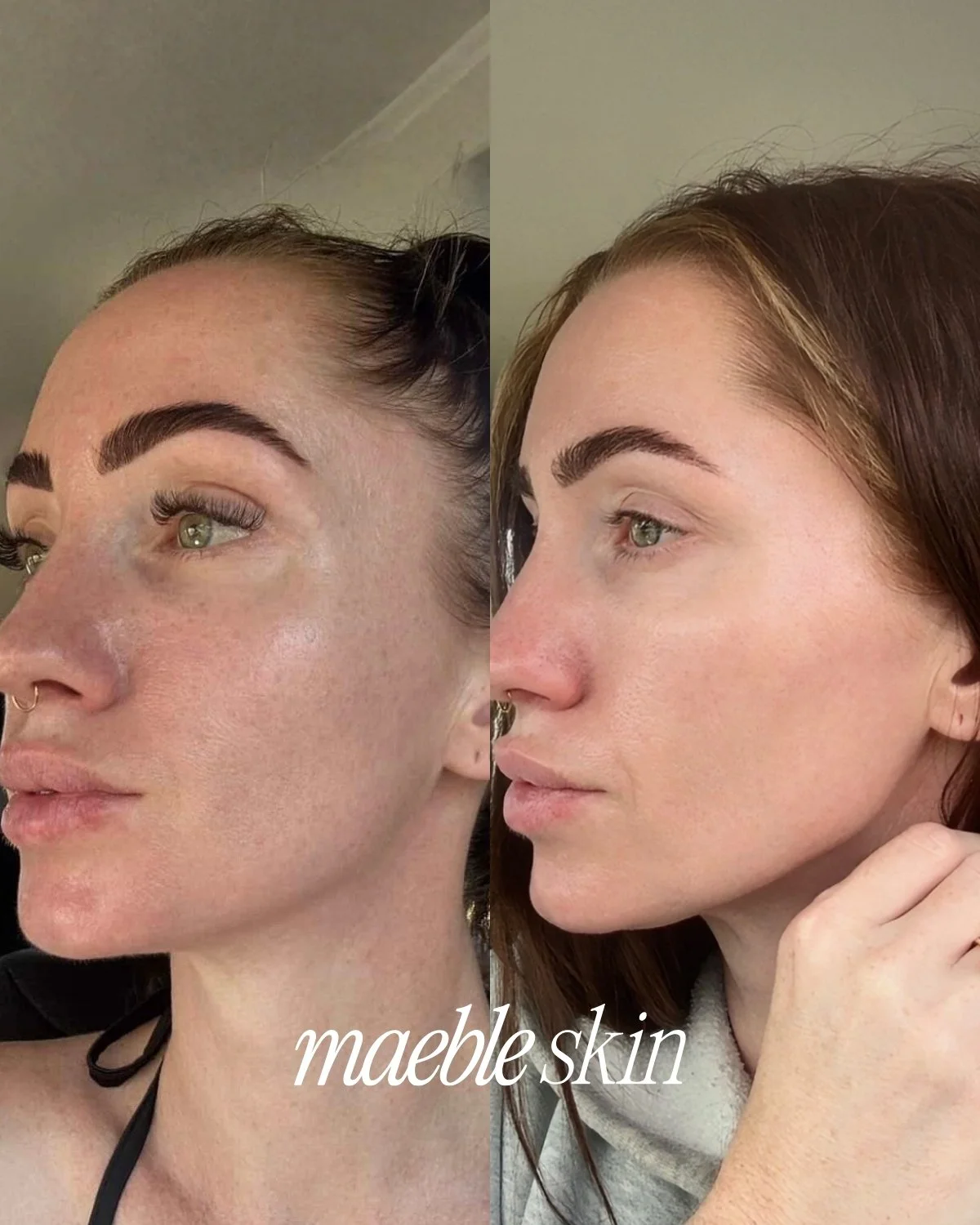 Side-by-side comparison photo of a woman with visible skin imperfections on the left and clear, smooth skin on the right, labeled 'mable skin.'