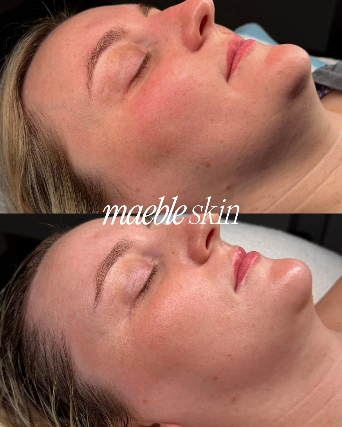 Comparison of a woman's face before and after a skin treatment highlighting smoother and clearer skin, with the words 'mable skin' overlaid on the image.