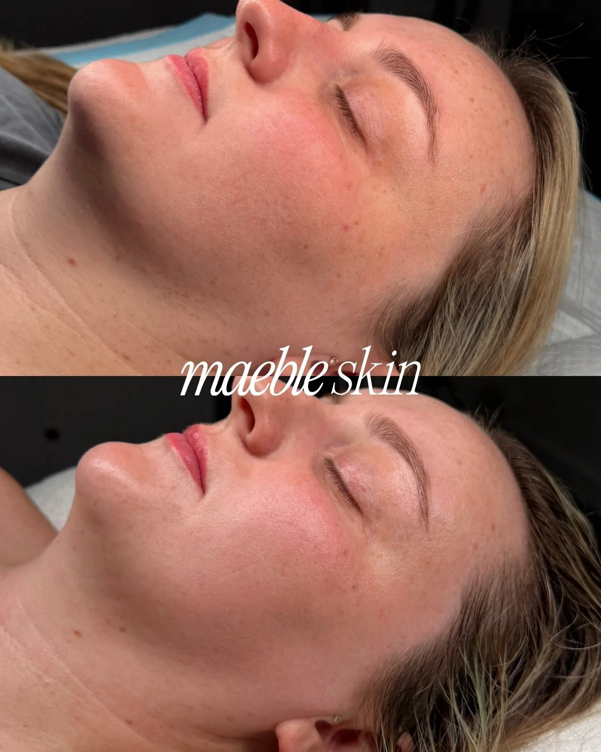 Close-up of a woman's face before and after a skin treatment, showing improved complexion with smoother, more radiant skin.