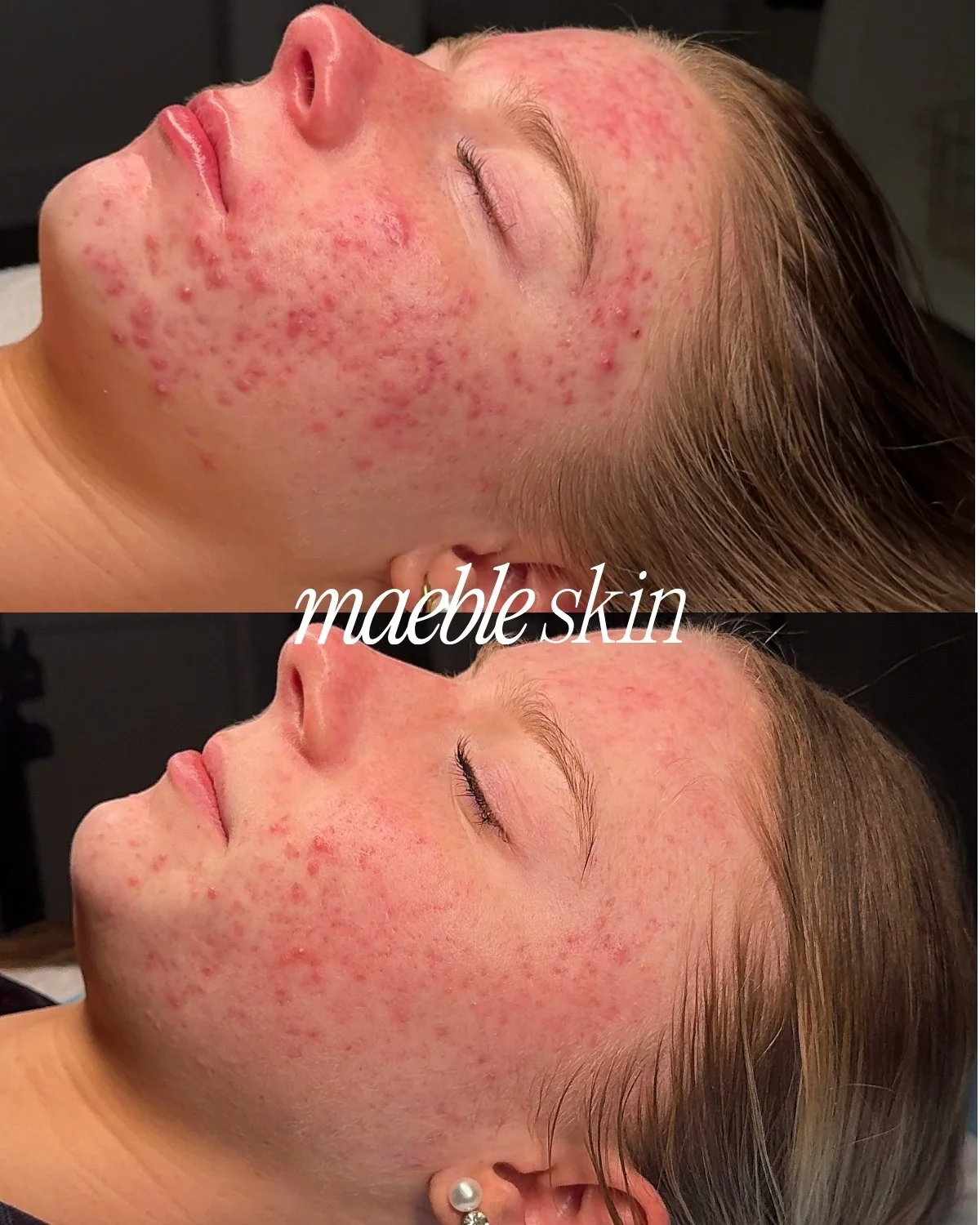 Close-up of a woman's face with red, inflamed skin and acne, before and after skincare treatment, labeled 'maeble skin'.