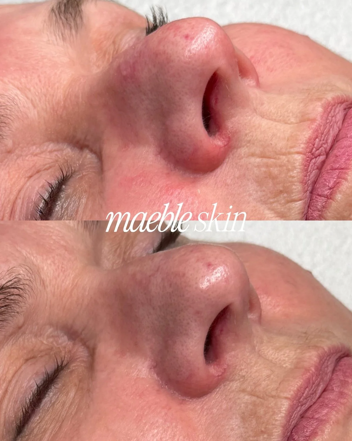 Close-up of a person's nose and cheek area before and after skin treatment, showing smoother skin with reduced redness and blemishes.