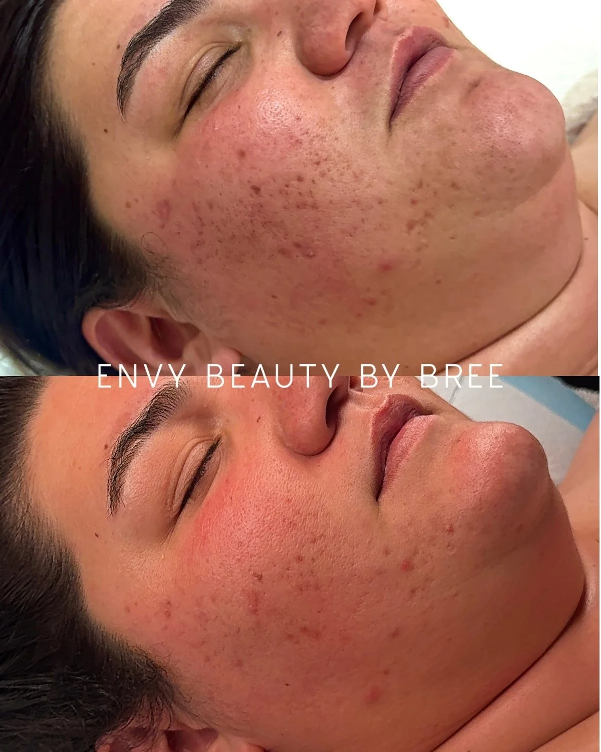 Side-by-side comparison of a person's face before and after a skincare treatment showing significant reduction in acne and skin clarity. The top image shows inflamed, red acne on the cheek, while the bottom image shows clearer skin with diminished bl