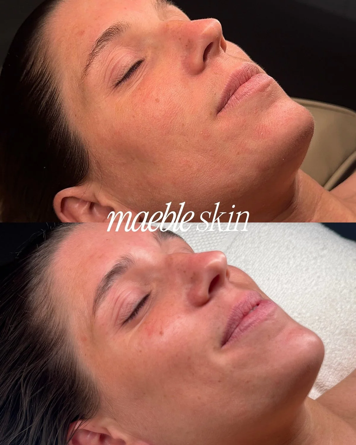 Comparison of a woman's face before and after a skincare treatment, showing smoother skin after. Text overlay says 'maeble skin'.