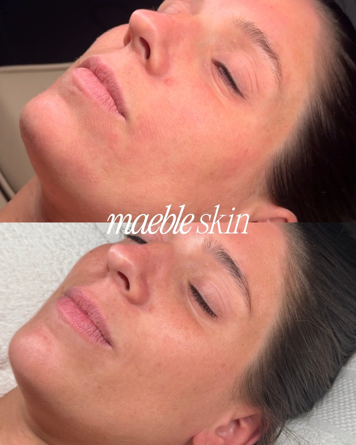 Comparison of skin before and after treatment showing improved, smoother, and more radiant skin labeled 'maeble skin' in the center.