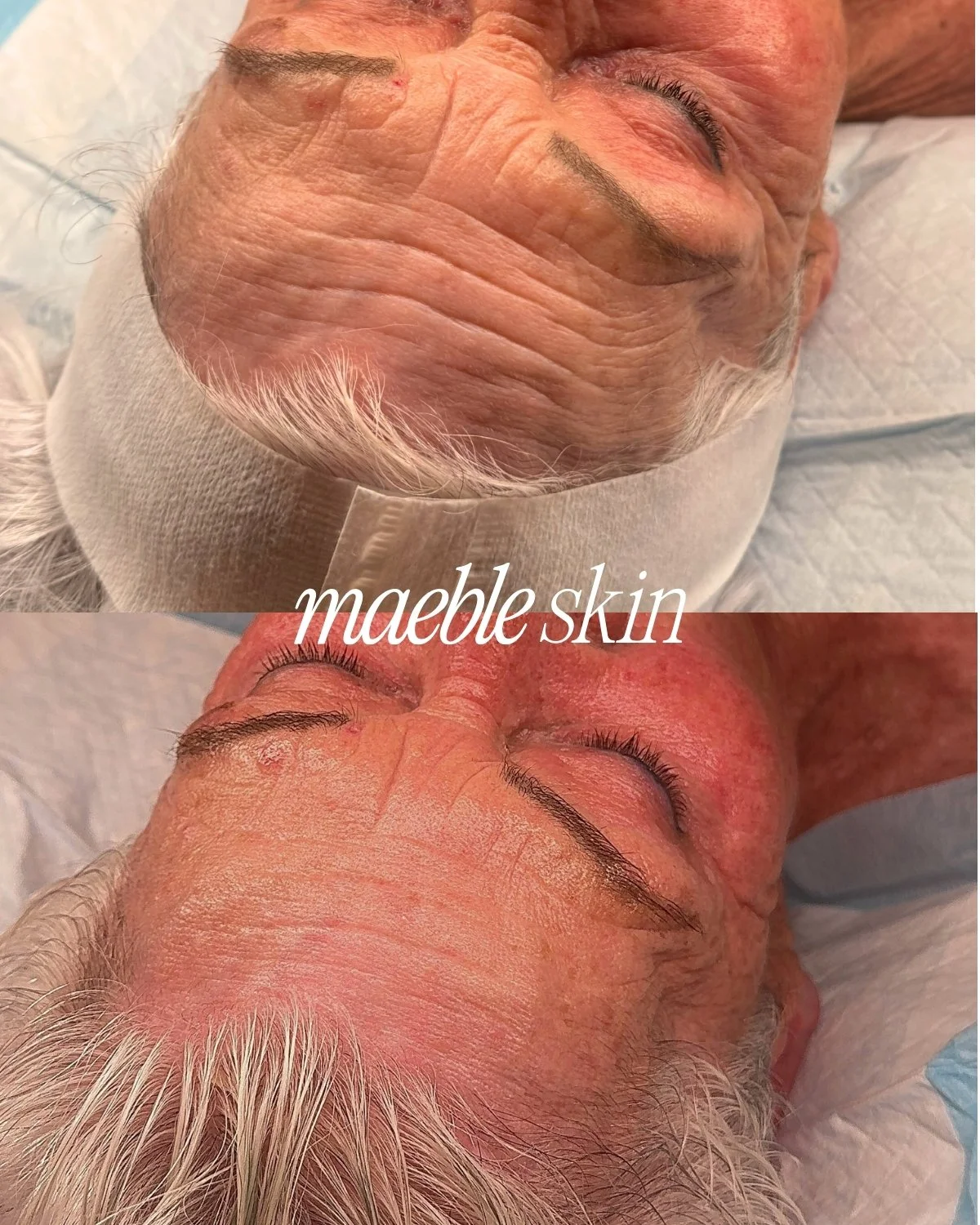 Close-up of a man's face showing before and after skin treatment, labeled 'maeble skin,' with visible improvement in skin texture, wrinkles, and redness.