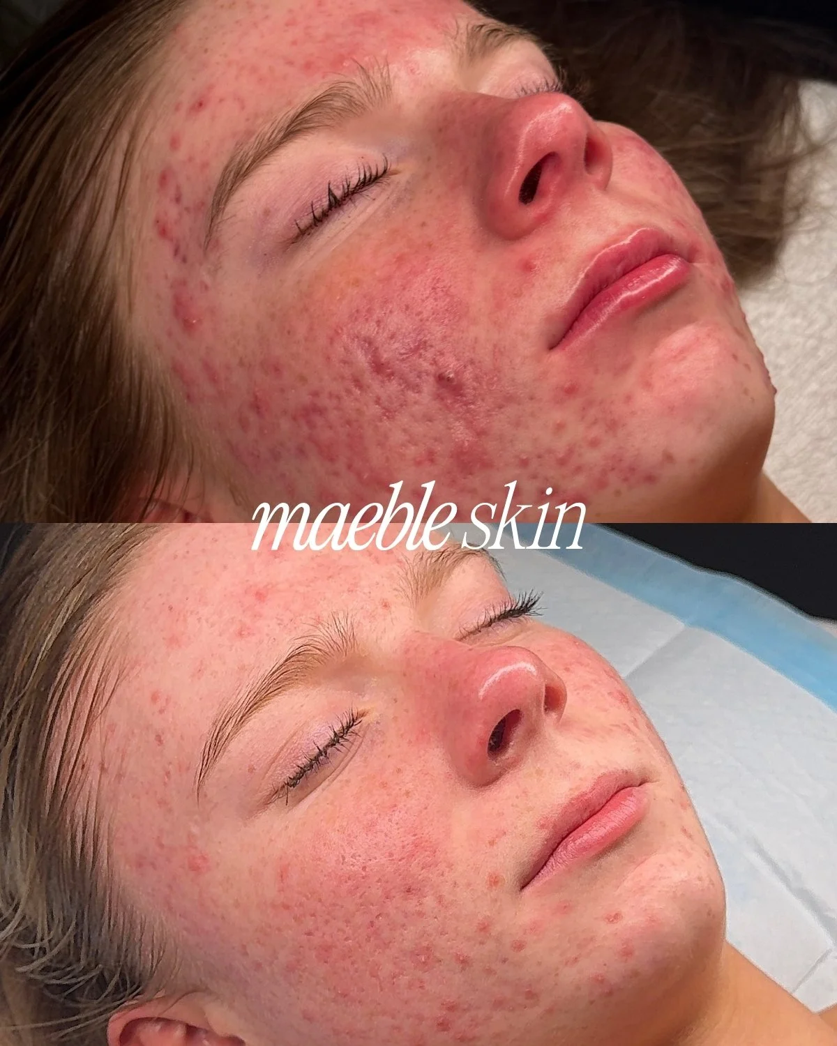 Before and after photos showing improvement in a woman's skin condition, which was affected by acne or skin inflammation, with text overlay labeled "mabe skin."