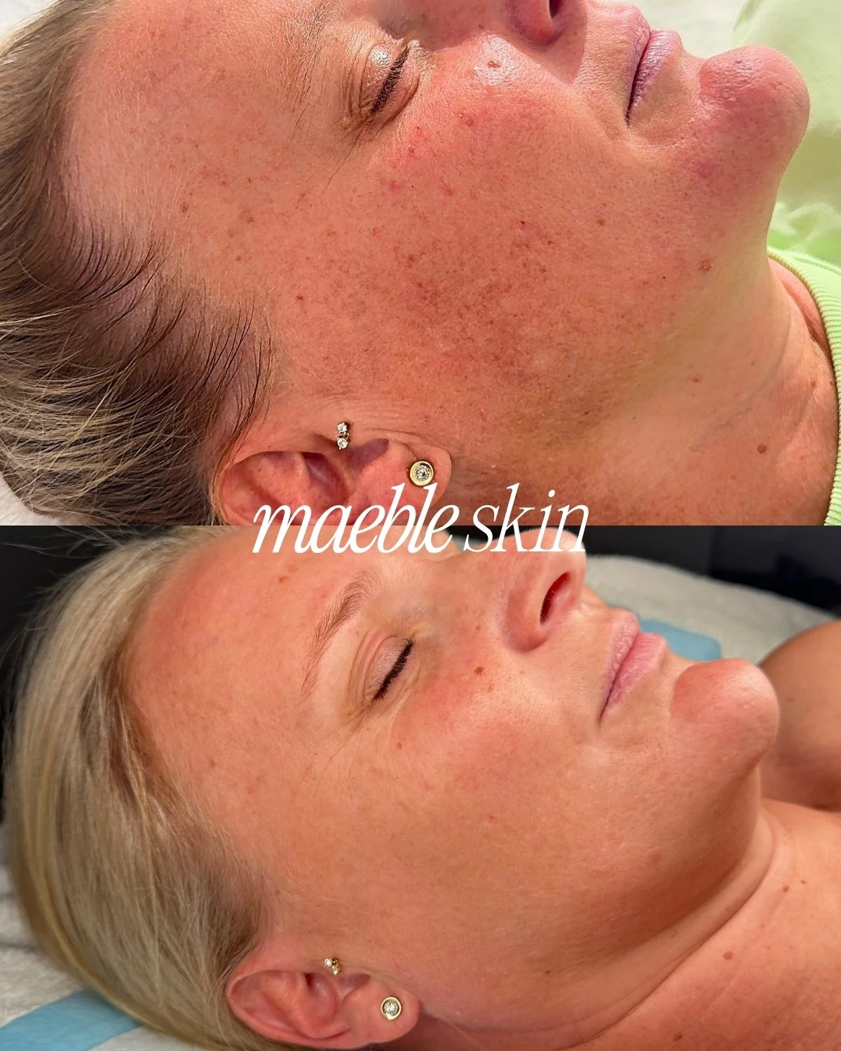 Comparison of a woman's face with and without visible freckles, showing clear skin after treatment labeled 'maeble skin'.