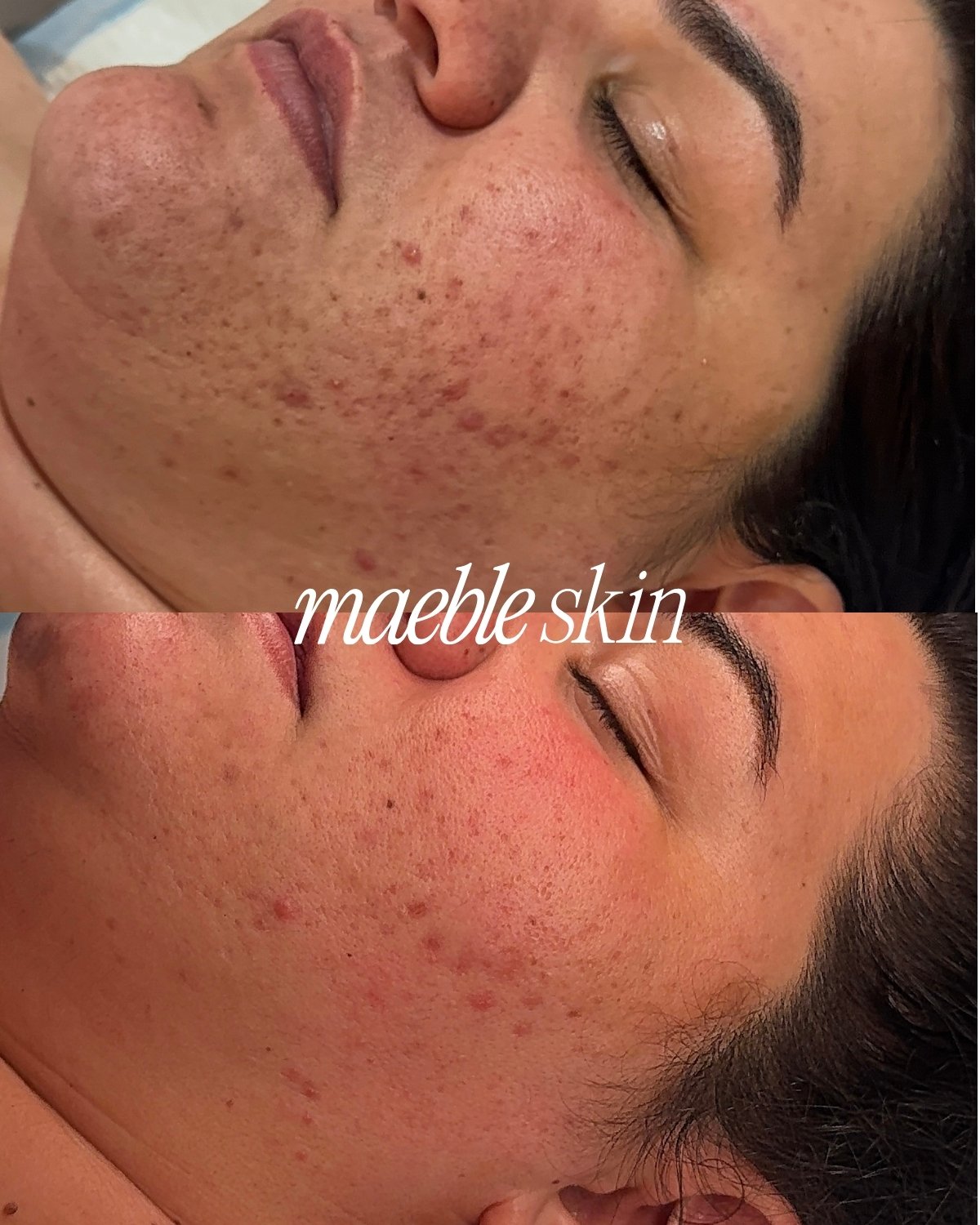 A side-by-side comparison of a person's facial skin before and after treatment, showing improvement in skin texture and reduction of blemishes. The text overlay reads 'maeble skin'.