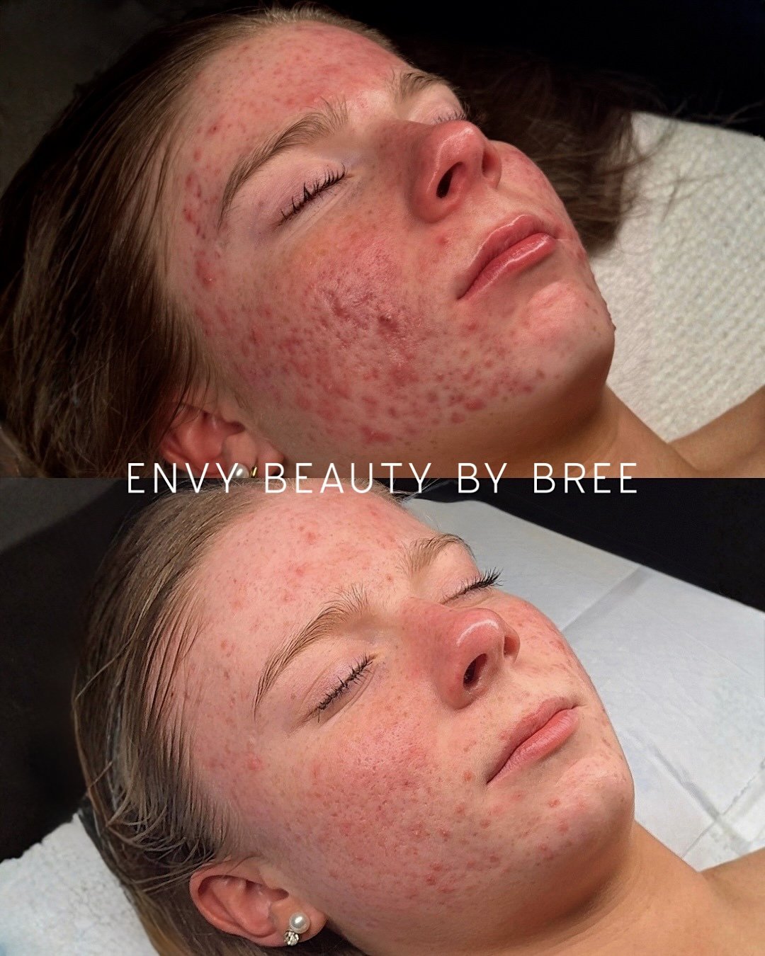 Before and after images showing a woman with acne and red skin, with the after image showing clearer skin, indicating a skincare treatment.