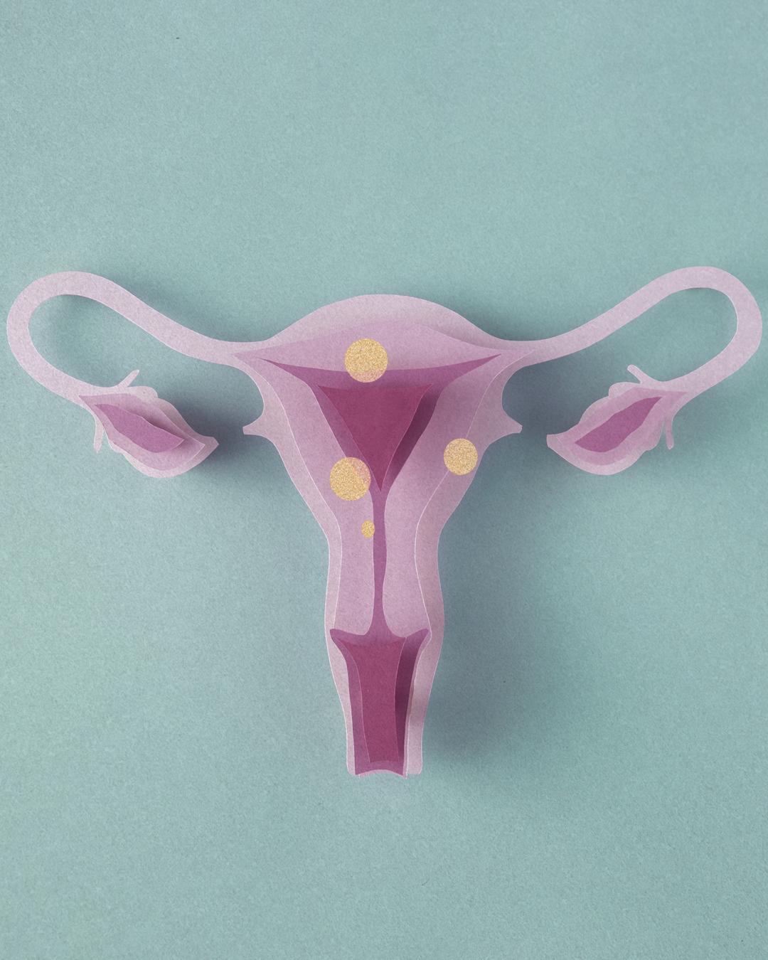Ilustración digital de un útero femenino con trompas y ovarios, con marcadores resaltando posibles áreas de interés en el sistema reproductor femenino.