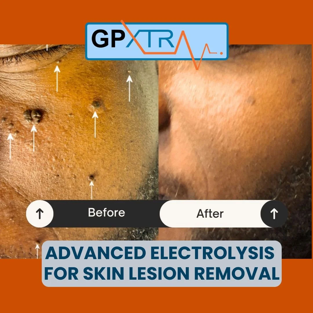 Before and after advanced electrolysis for skin lesion removal