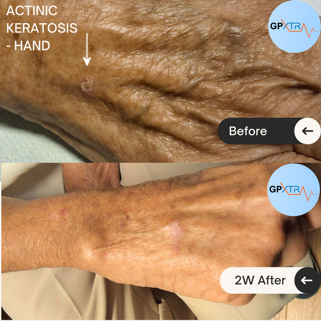 Before-and-after comparison of a hand's skin following two weeks of treatment, showing rough patches at the top labeled 'Before' and smoother skin below labeled '2W After' Results.