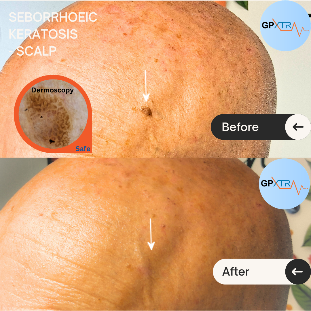 Comparison of a scalp before and after treatment for seborrheic keratosis, with a dermoscopy inset showing skin details and a logo of GPxtra in the top right corner.