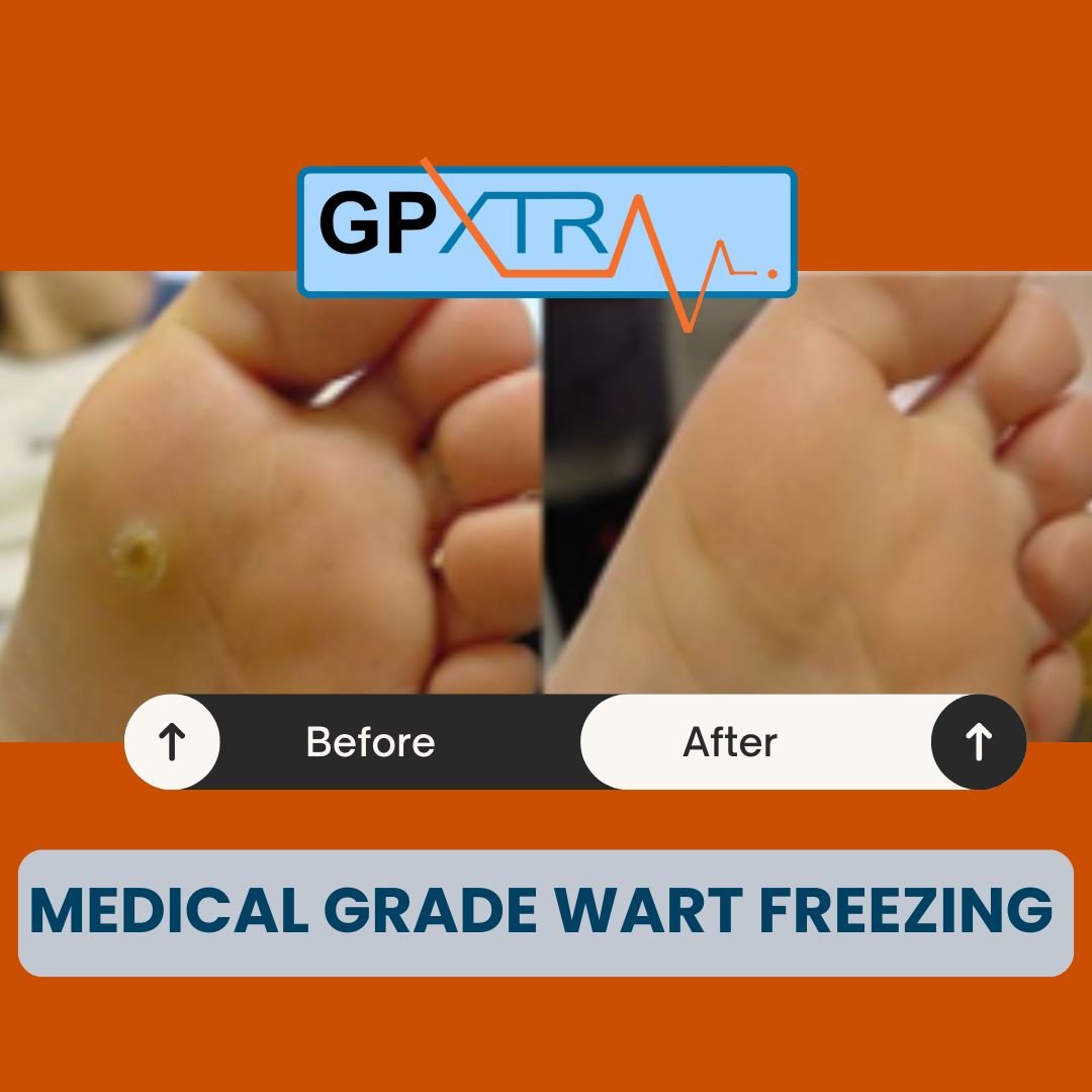 Before and after wart removal treatment using medical-grade freezing