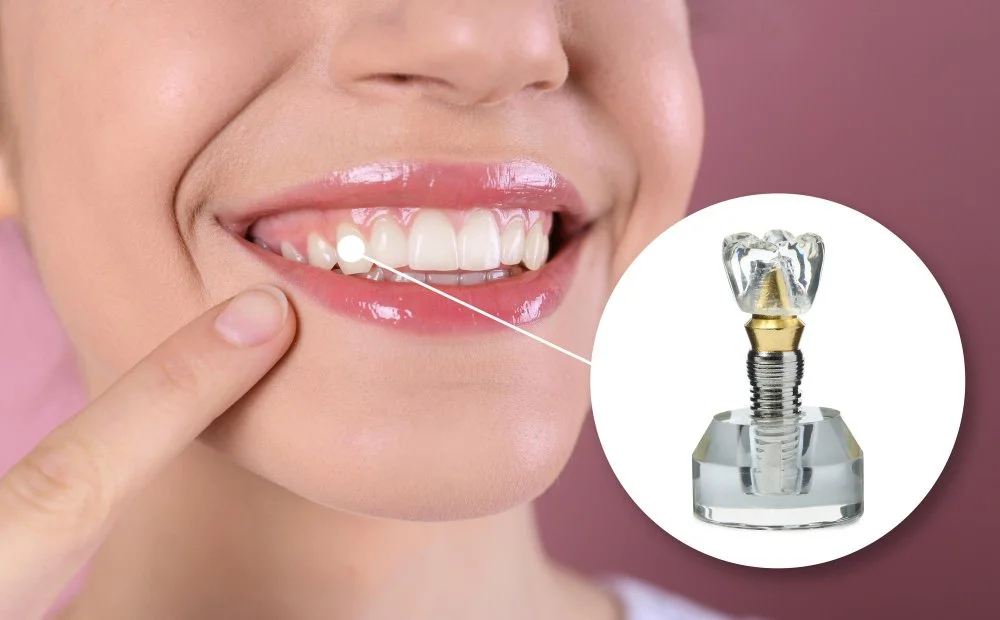 Complete Smile Restoration with Advanced Dental Implants in Whittier