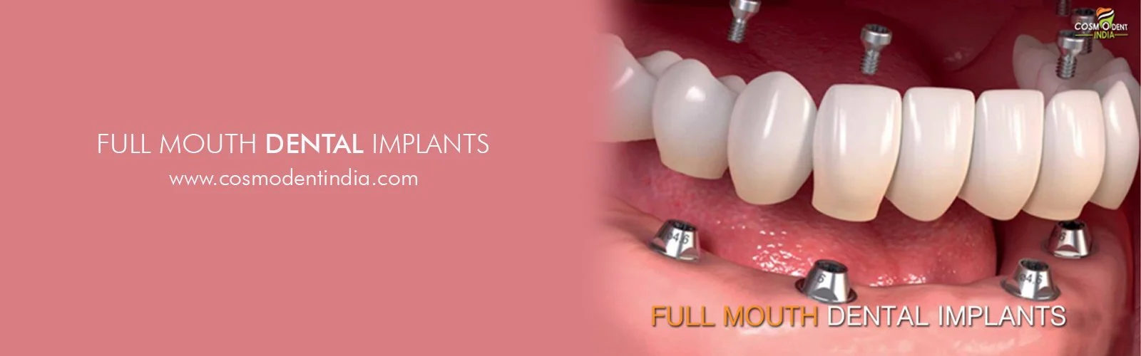 Full Smile Restoration with Modern Dental Implants