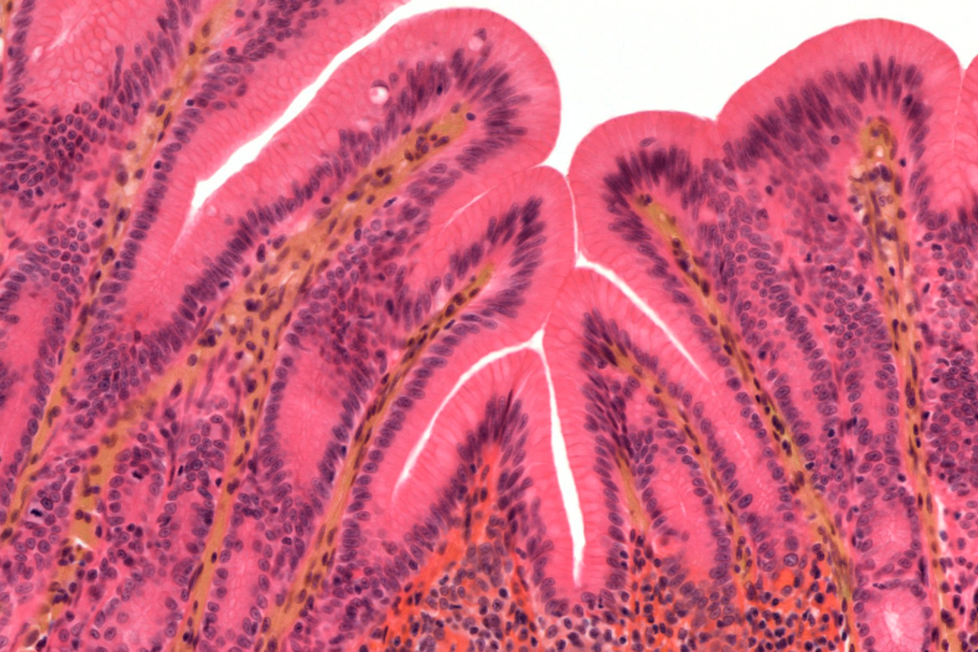 What is leaky gut and how do I fix it?